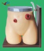 Senior fistula ostomy care model